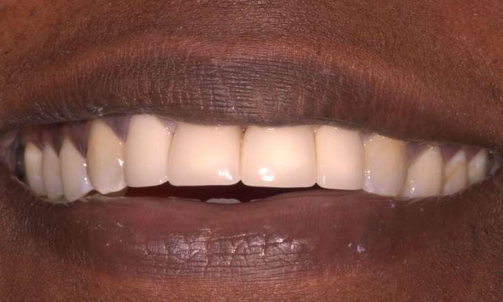 Anterior-Crowns-Case-After-Image