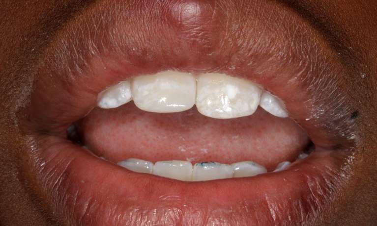 Child-broken-front-tooth-fixed-with-composite-After-Image