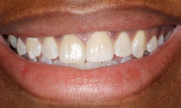 Fractured-tooth-replaced-with-a-crown-After-Image