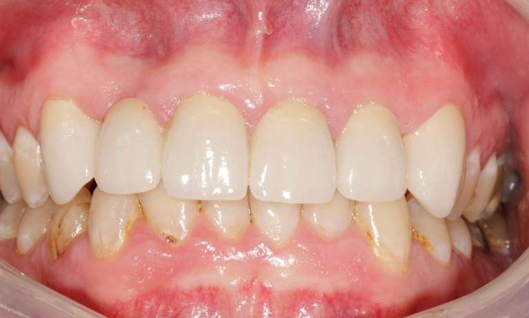 Full-Anterior-Case-After-Image