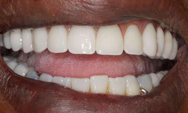 Immediate-Dentures-After-Image