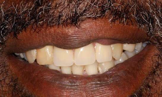 Partial-Denture-After-Image