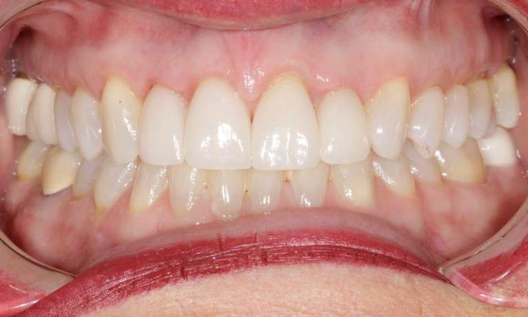 Veneers-Case-After-Image