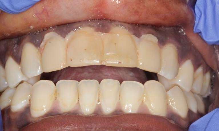 Anterior-Crowns-Case-Before-Image