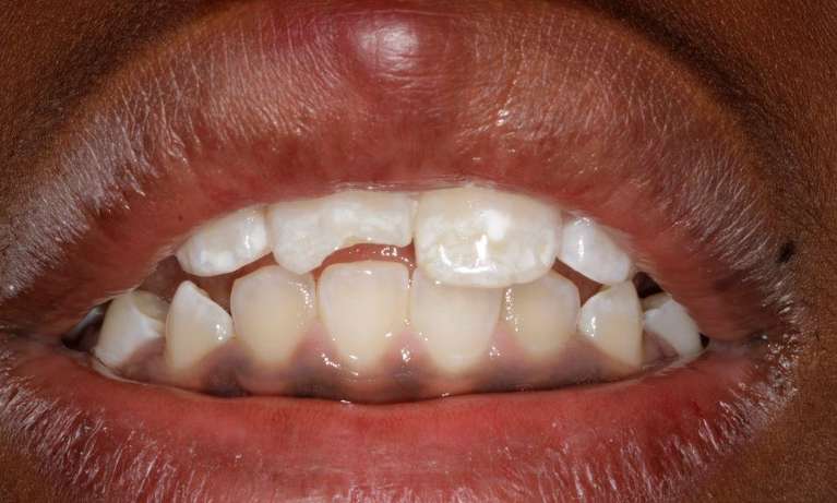 Child-broken-front-tooth-fixed-with-composite-Before-Image