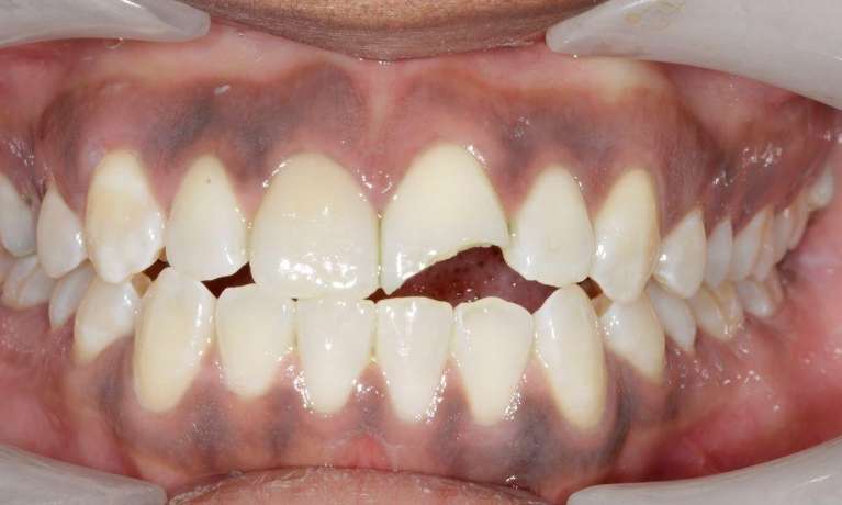 Fractured-tooth-replaced-with-a-crown-Before-Image