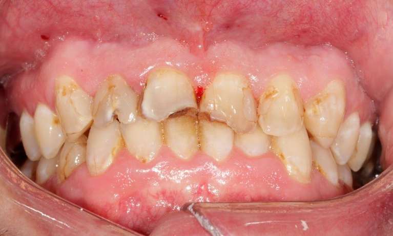 Full-Anterior-Case-Before-Image