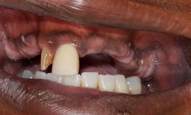 Immediate-Dentures-Before-Image