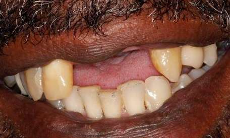 Partial-Denture-Before-Image